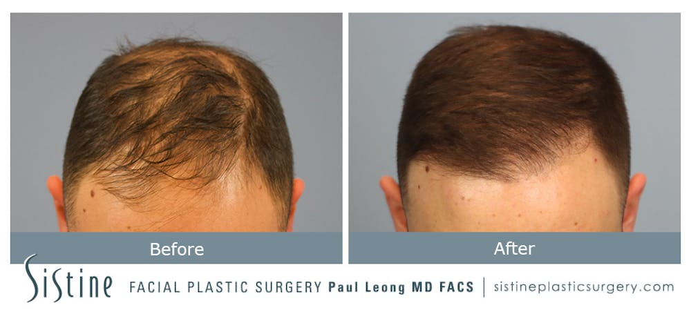 Hair Transplant Before & After Gallery - Patient 148239792 - Image 1
