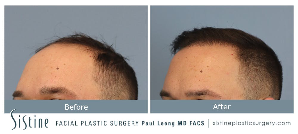 Hair Transplant Before & After Gallery - Patient 148239792 - Image 2