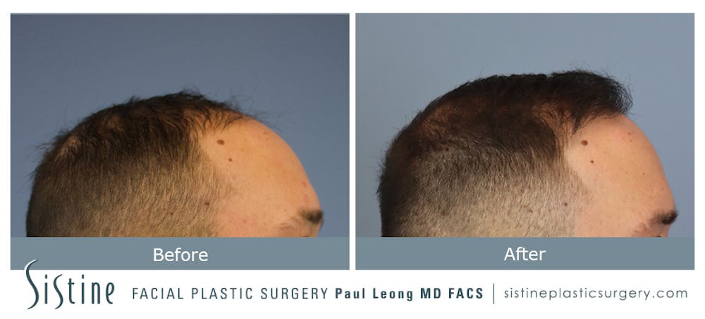 Hair Transplant Before & After Gallery - Patient 148239792 - Image 3