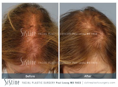 Hair Transplant Before & After Gallery - Patient 148447546 - Image 1