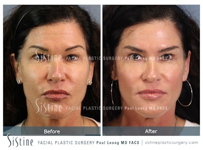 Before & After