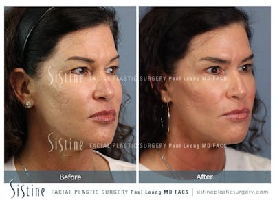 Before & After