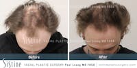 Hair Transplant Before & After Gallery - Patient 189379899 - Image 1
