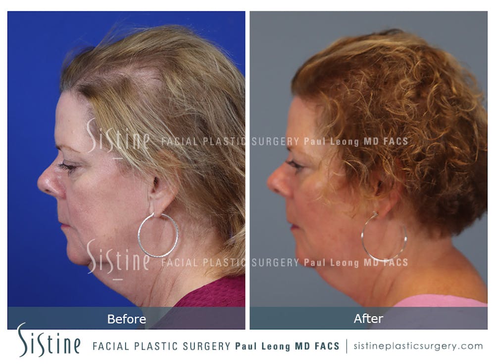 Hair Transplant Before & After Gallery - Patient 342106 - Image 5