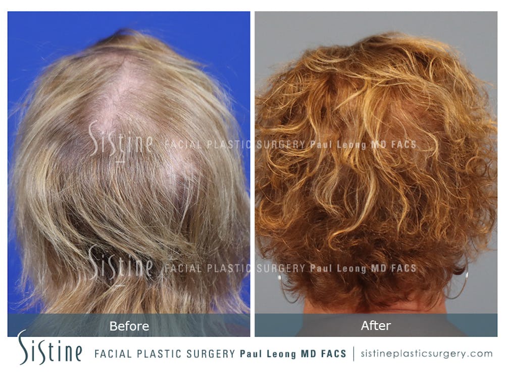 Hair Transplant Before & After Gallery - Patient 342106 - Image 7