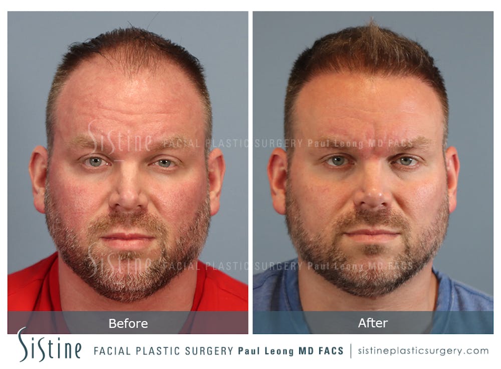 Hair Transplant Before & After Gallery - Patient 412334 - Image 1