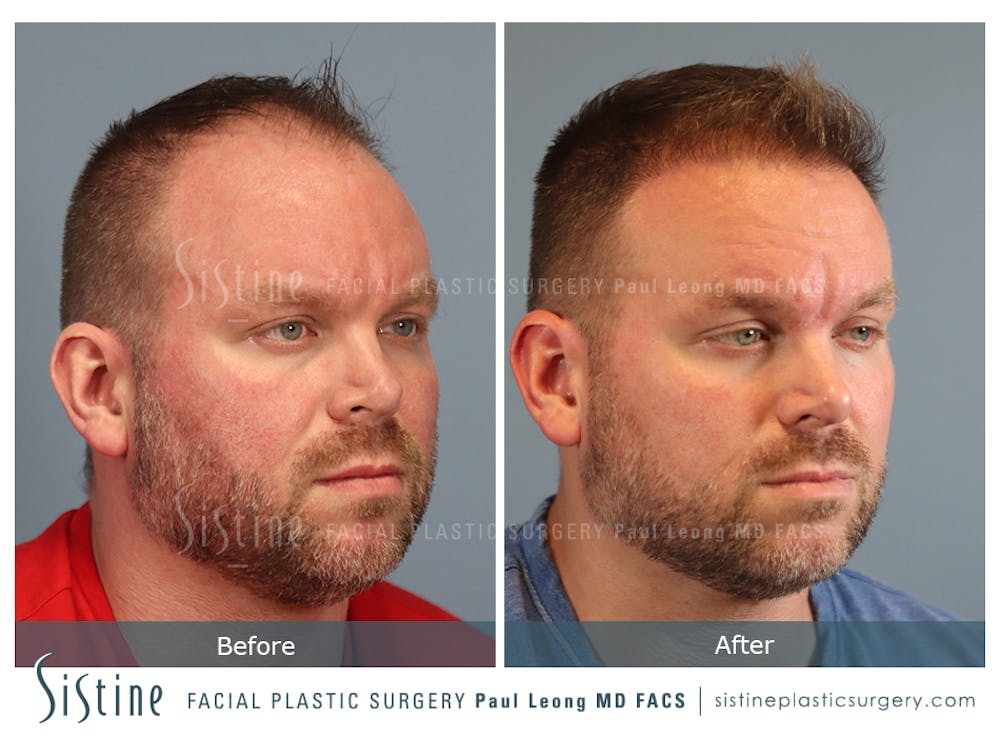 Hair Transplant Before & After Gallery - Patient 412334 - Image 2