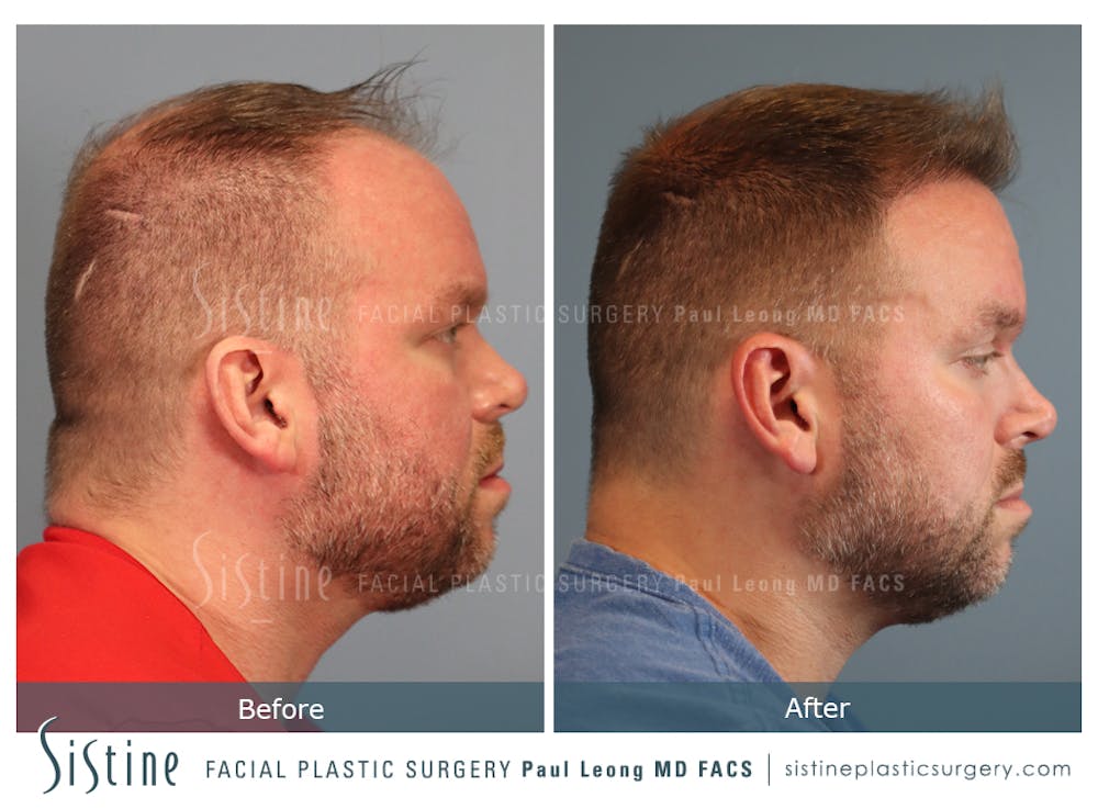 Hair Transplant Before & After Gallery - Patient 412334 - Image 3