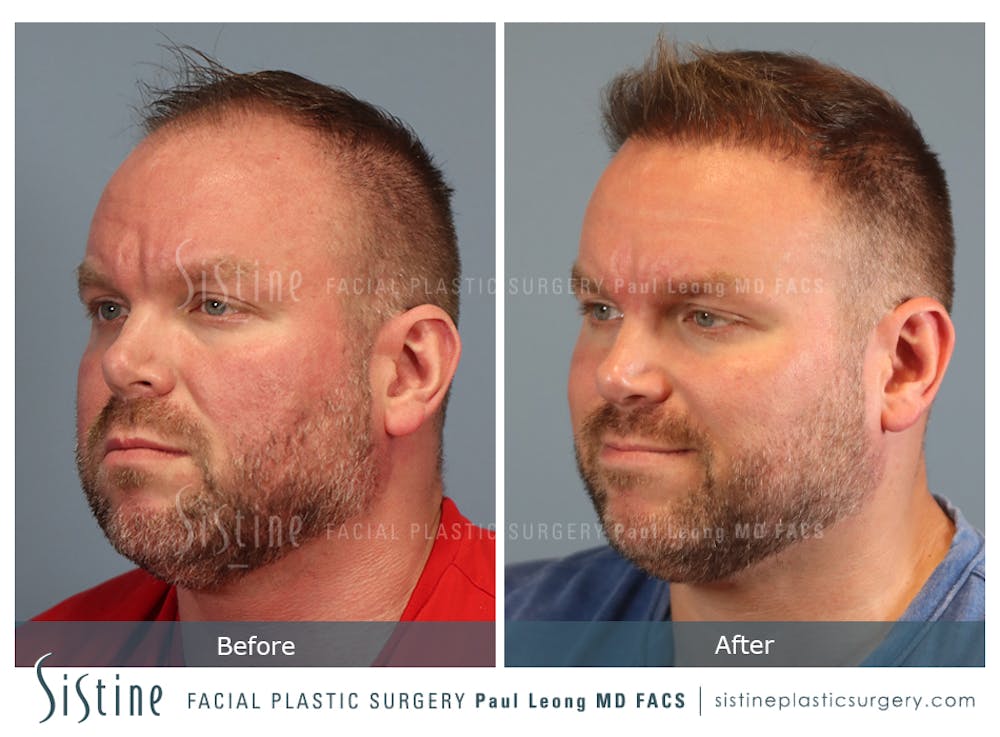 Hair Transplant Before & After Gallery - Patient 412334 - Image 4
