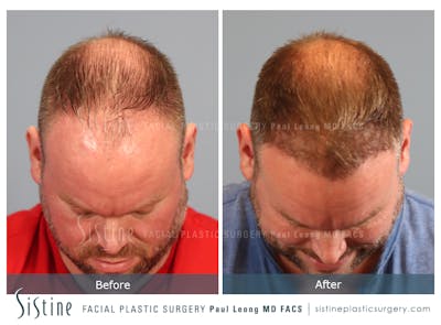 Hair Transplant Before & After Gallery - Patient 412334 - Image 6