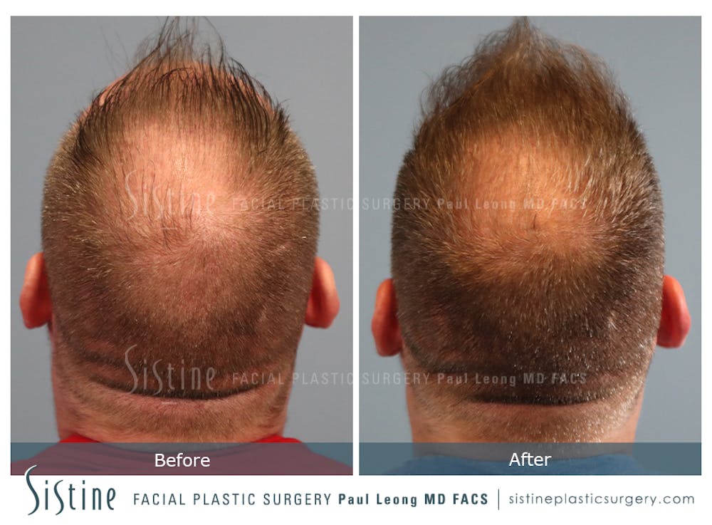 Before & After