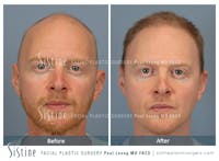 Hair Transplant Before & After Gallery - Patient 229259 - Image 1