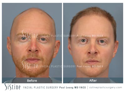 Hair Transplant Before & After Gallery - Patient 229259 - Image 1
