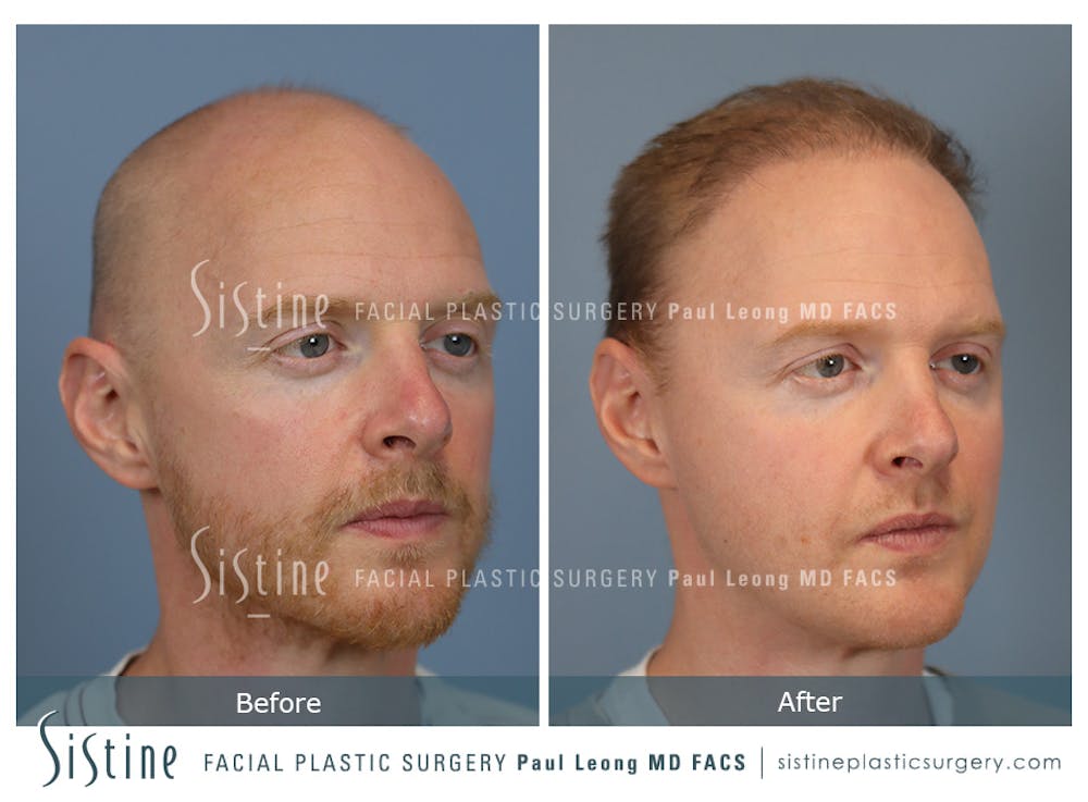 Hair Transplant Before & After Gallery - Patient 229259 - Image 2