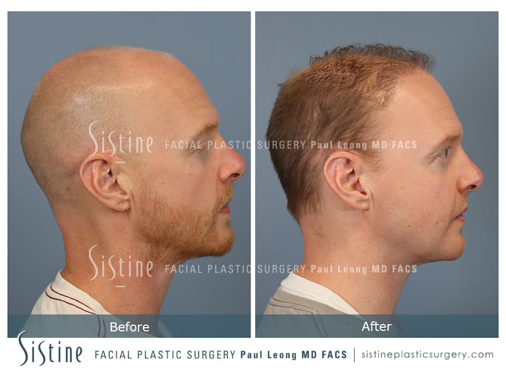 Hair Transplant Before & After Gallery - Patient 229259 - Image 3