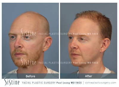 Hair Transplant Before & After Gallery - Patient 229259 - Image 4