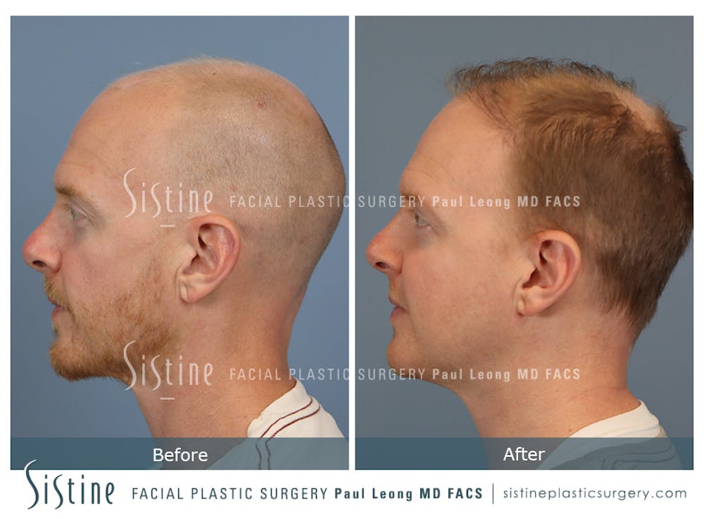 Hair Transplant Before & After Gallery - Patient 229259 - Image 5