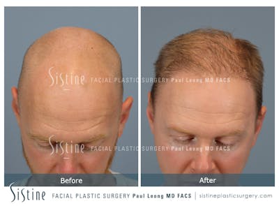 Hair Transplant Before & After Gallery - Patient 229259 - Image 6