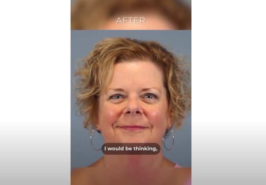 Hair Restoration Patient