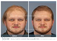 Hair Transplant Before & After Gallery - Patient 308057 - Image 1