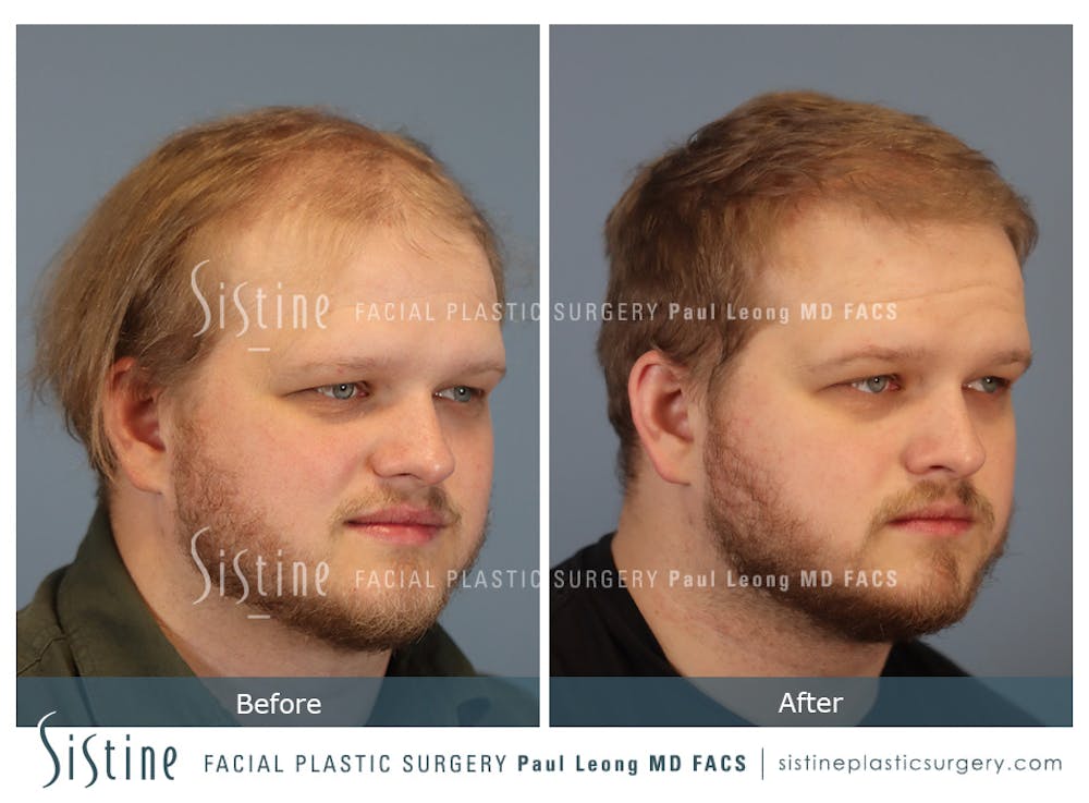 Hair Transplant Before & After Gallery - Patient 308057 - Image 3
