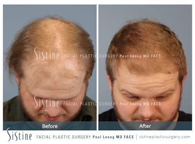 Hair Transplant Before & After Gallery - Patient 308057 - Image 2