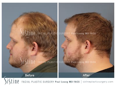 Hair Transplant Before & After Gallery - Patient 308057 - Image 6