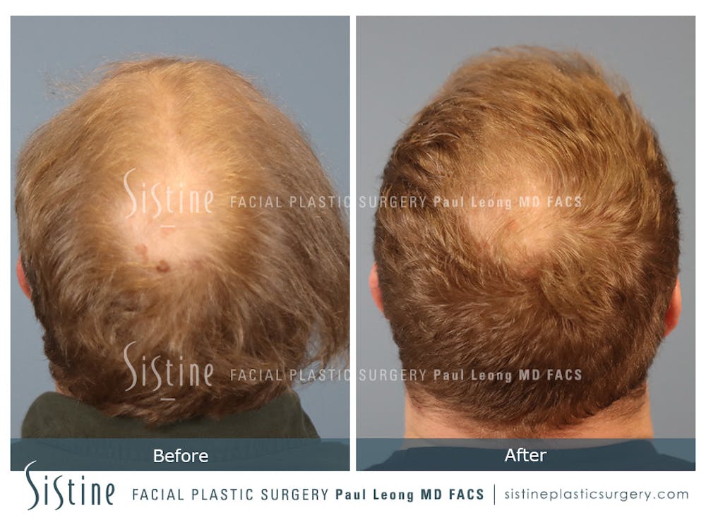 Hair Transplant Before & After Gallery - Patient 308057 - Image 7