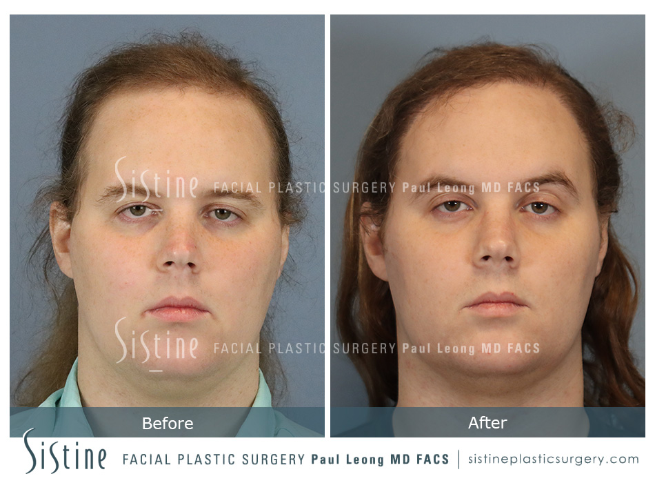 Before & After