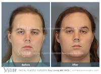 Hair Transplant Before & After Gallery - Patient 424174 - Image 1