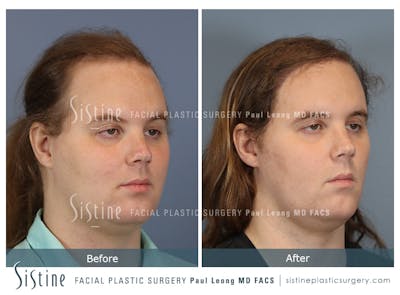Before & After