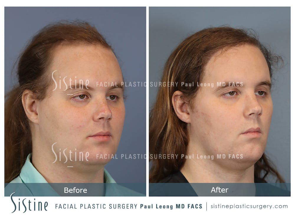 Hair Transplant Before & After Gallery - Patient 424174 - Image 2