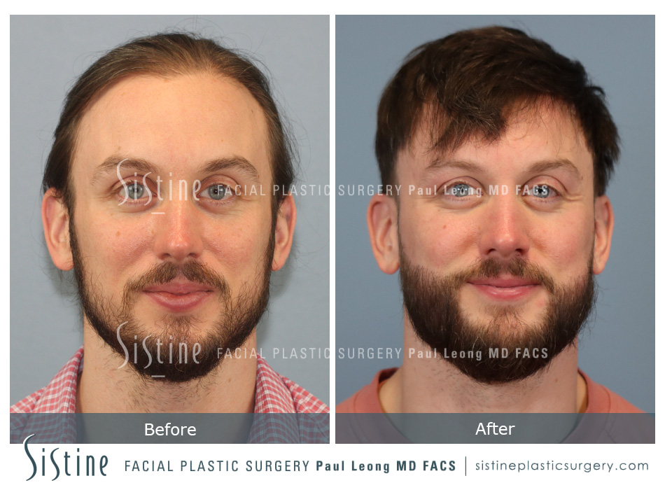 Hair Transplant