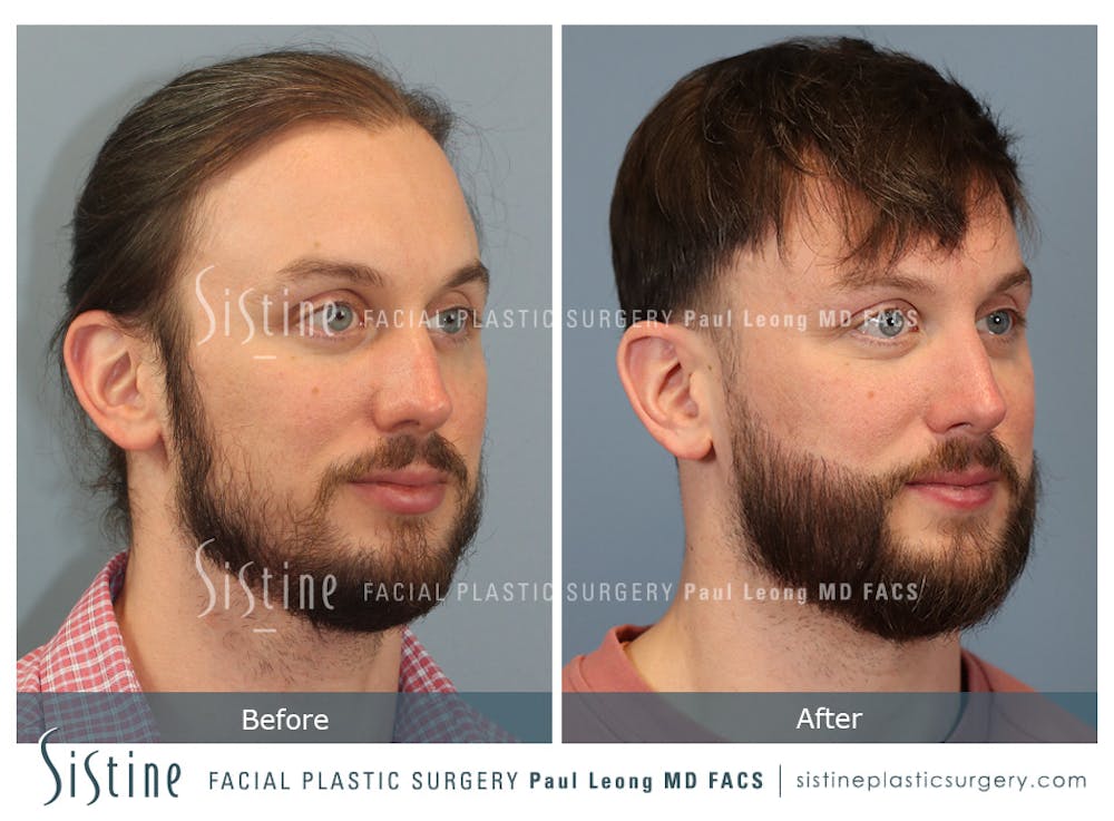Before & After