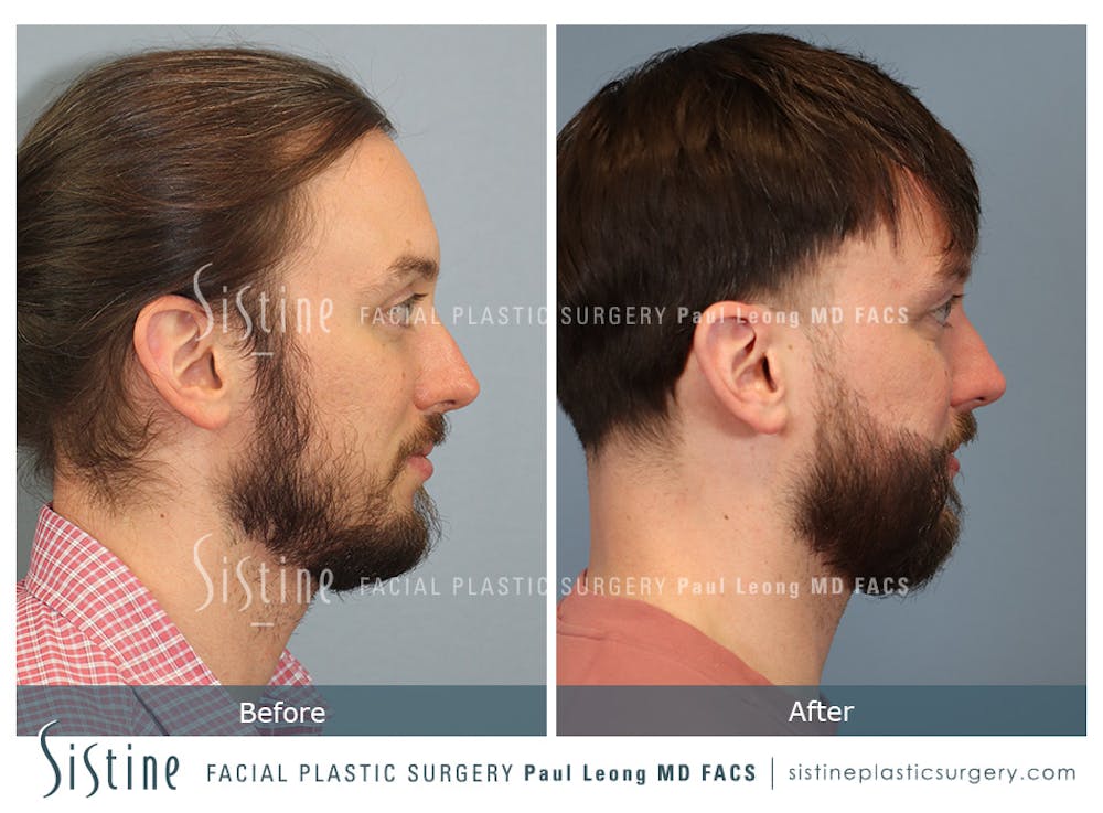 Before & After
