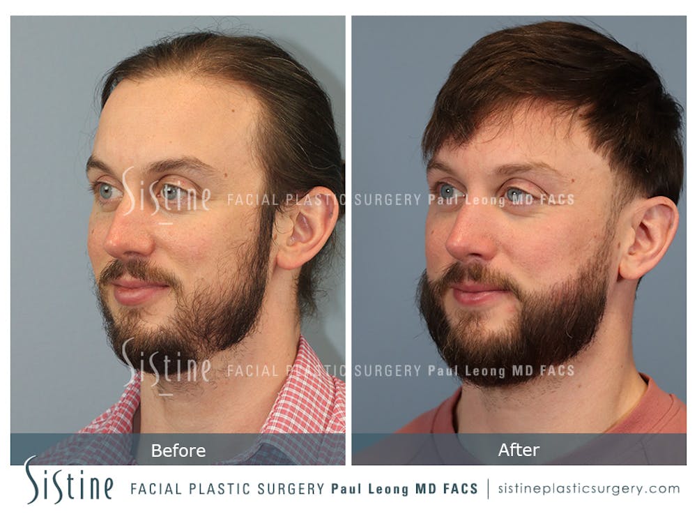 Before & After
