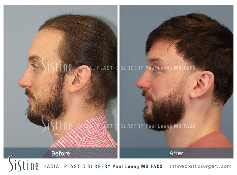 Before & After