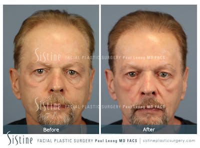 Before & After