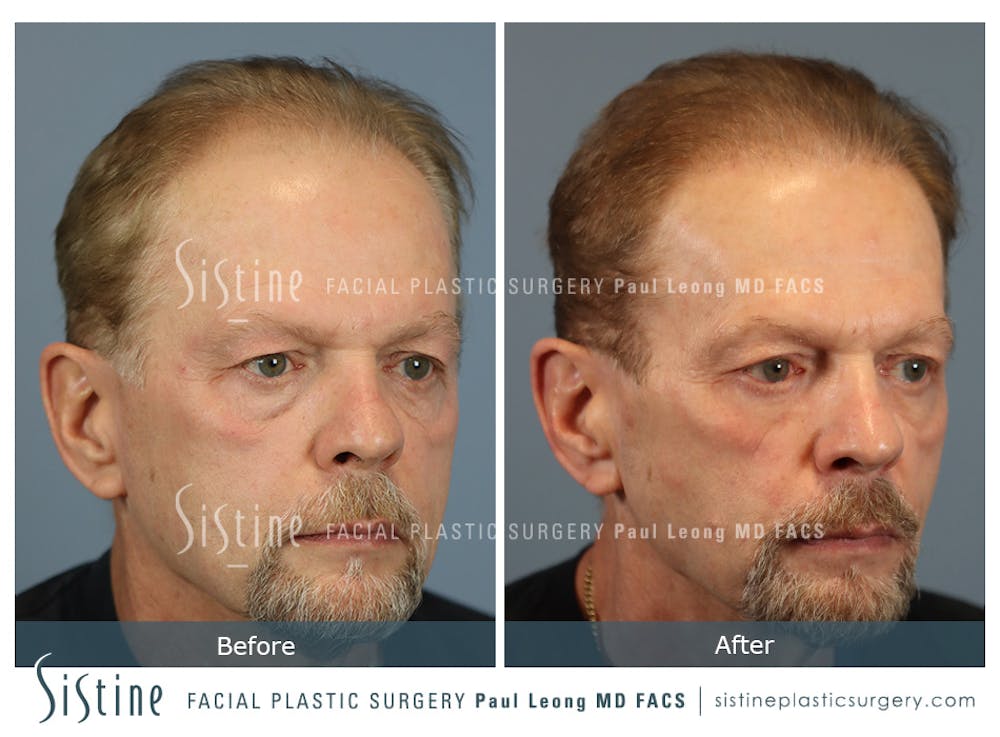 Before & After