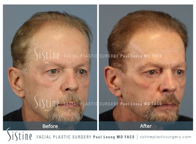 Before & After