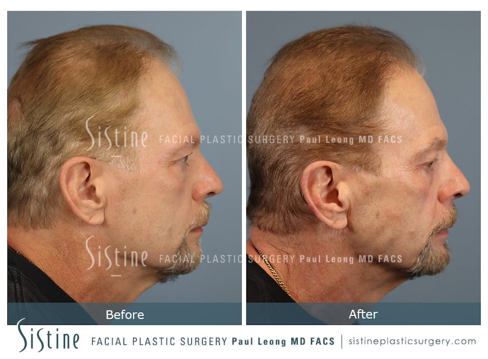 Before & After