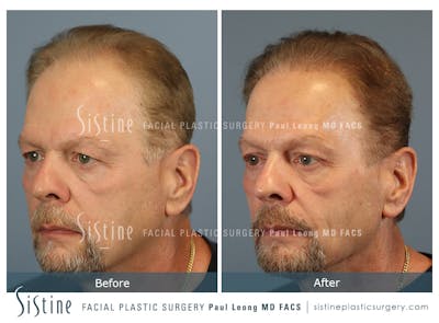 Before & After
