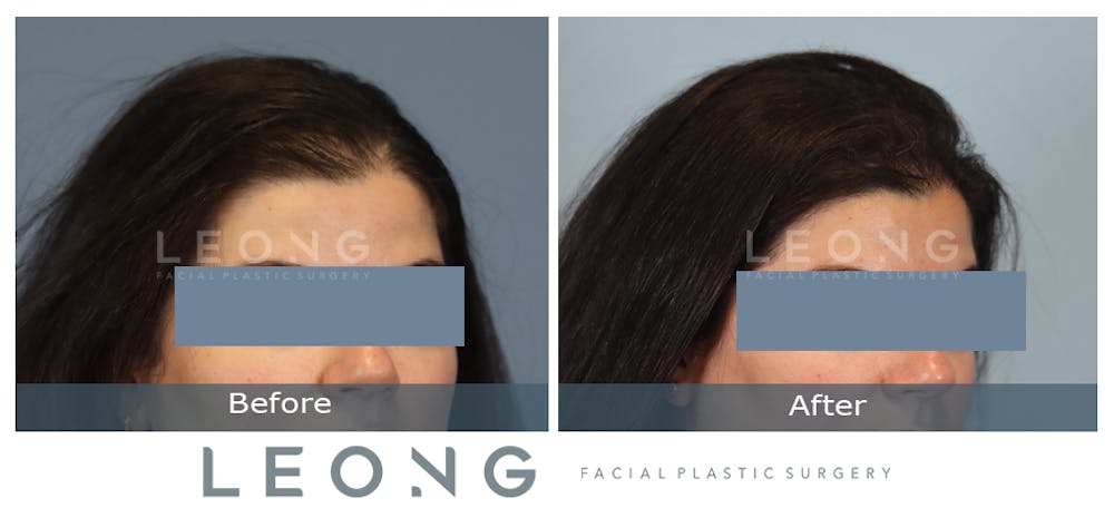 Hair Transplant Before & After Gallery - Patient 179305 - Image 3