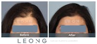 Hair Transplant Before & After Gallery - Patient 179305 - Image 1
