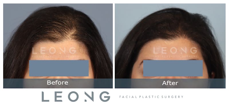 Hair Transplant Before & After Gallery - Patient 179305 - Image 1