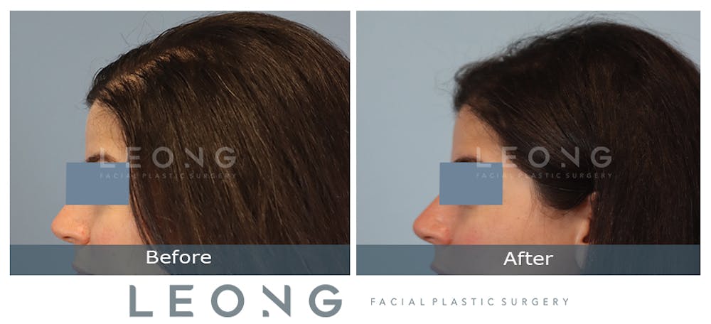 Hair Transplant Before & After Gallery - Patient 179305 - Image 5
