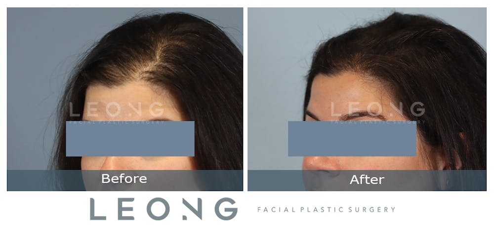 Hair Transplant Before & After Gallery - Patient 179305 - Image 4