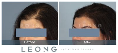 Hair Transplant Before & After Gallery - Patient 179305 - Image 4