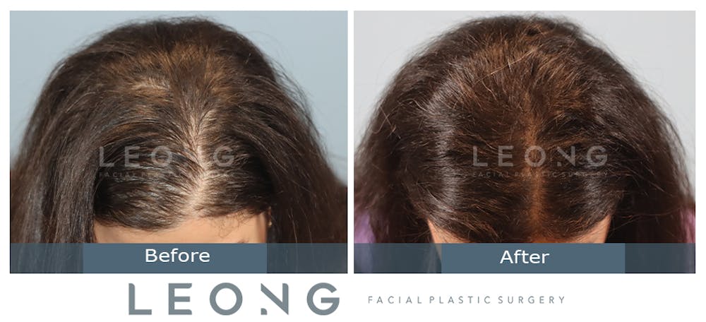 Hair Transplant Before & After Gallery - Patient 179305 - Image 2
