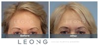 Hair Transplant Before & After Gallery - Patient 214973 - Image 1